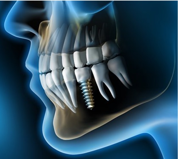 Dental Implants